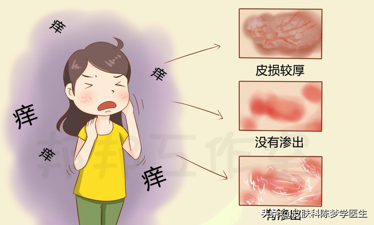 不同分期的湿疹怎么治疗,湿疹痒痒的有什么办法治好吗