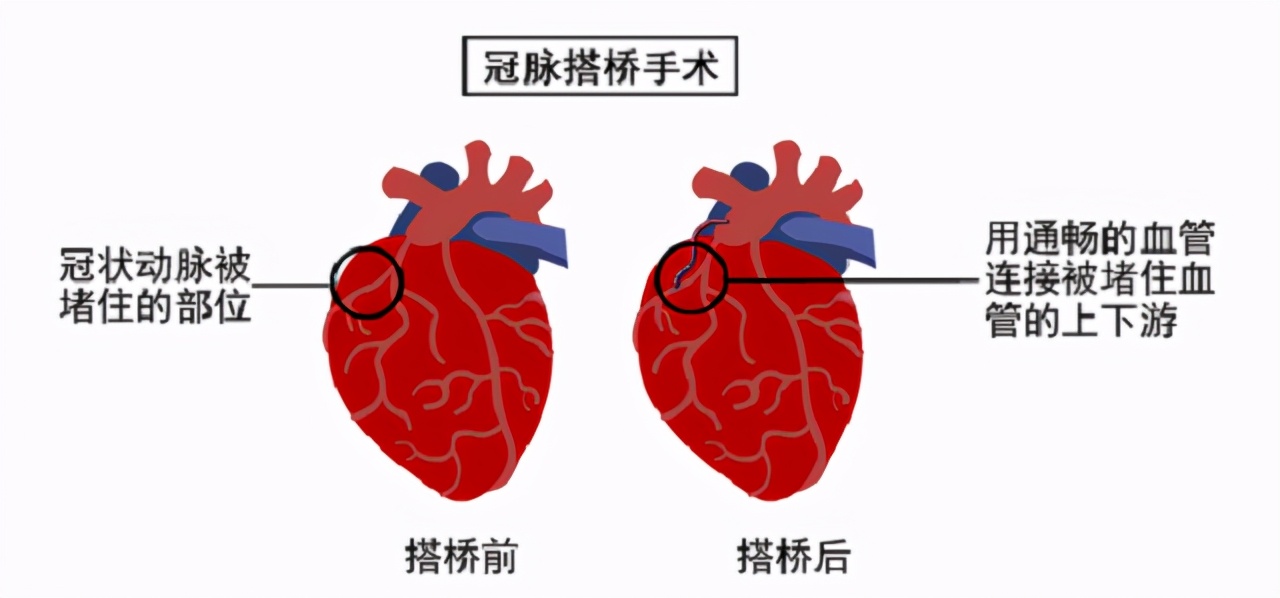 冠心病要静养还是多运动,冠心病人需要什么类型的运动