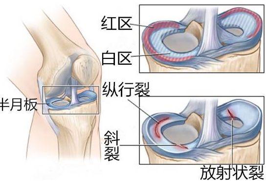 半月板损伤的成因和预防策略,关于半月板损伤的临床表现及诊断