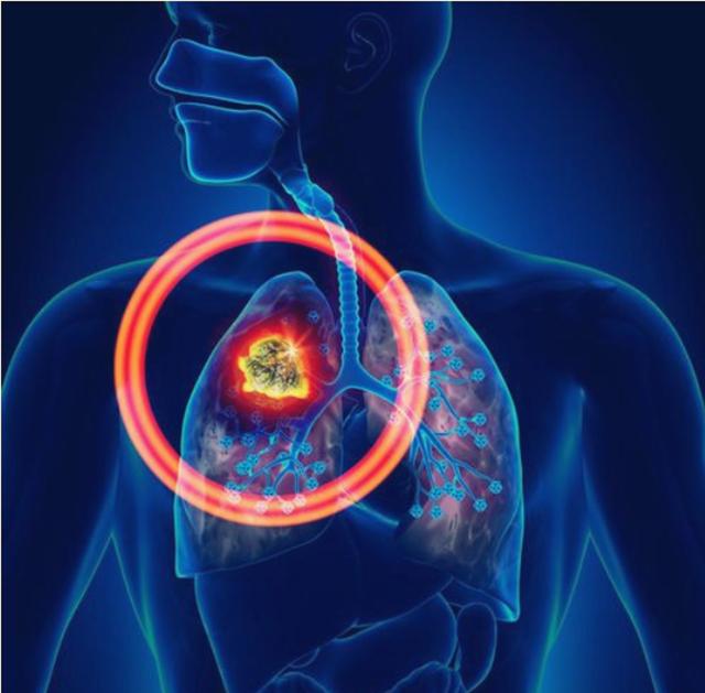 癌症晚期的妈妈抗癌5年,关于肺癌晚期的抗癌奇迹