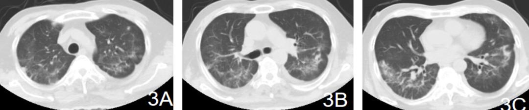 新冠症状容易与常见疾病症状混淆,症状和新冠一样怎么办