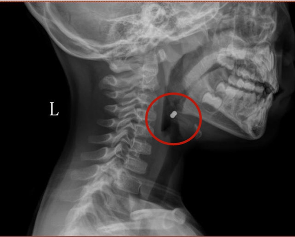 网红巴克球,巴克球对成年人的影响