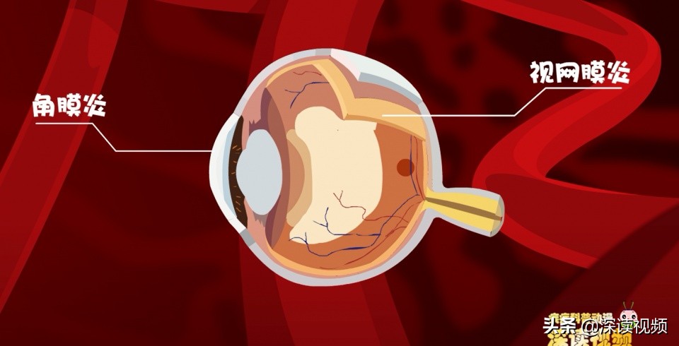 梅毒上热搜，隐私部位出现啥样要警惕？