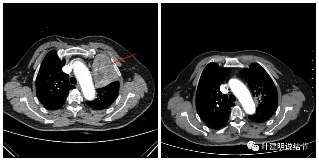 卡瑞利珠单抗治疗肺鳞癌有用吗,特瑞普利单抗对鳞癌治疗有效吗