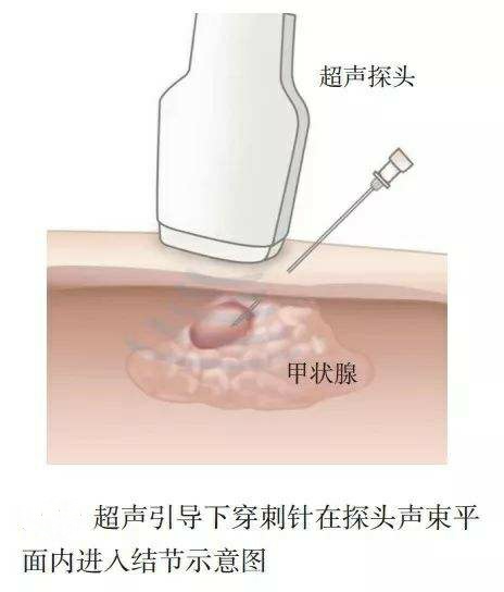 甲状腺结节怎么办才能好得快,甲状腺结节医生建议做穿刺的原因