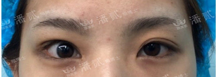 全切双眼皮提肌失败还能修复吗,什么是失败的双眼皮