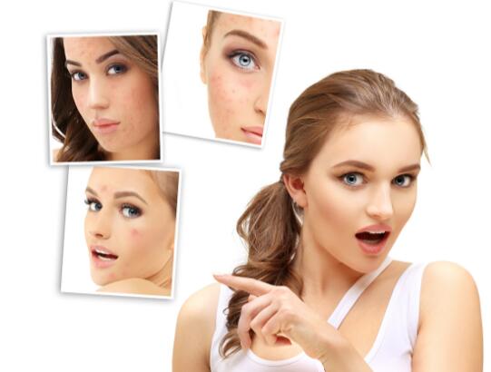 油烟使皮肤长痘怎么办,油烟大导致皮肤差怎么办