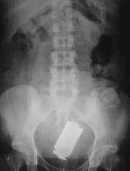 不作死就不会死，看看这些被人类搞进身体里的异物