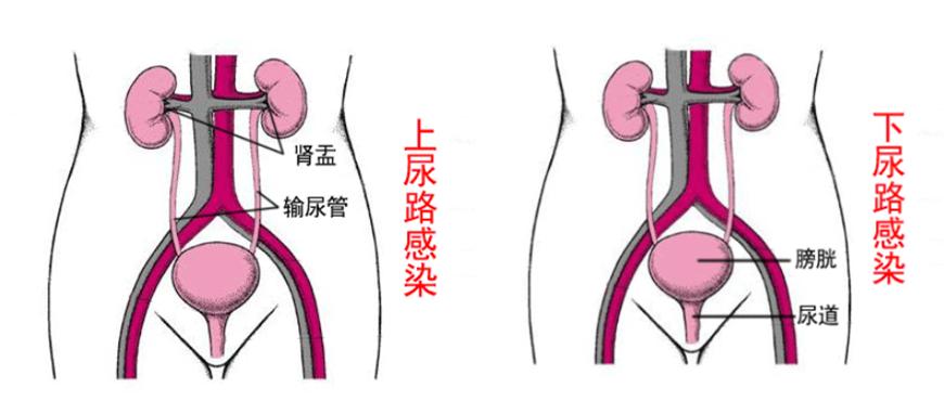 游泳后腰疼、发热、小便不适，原来是染上这种病，女性多发