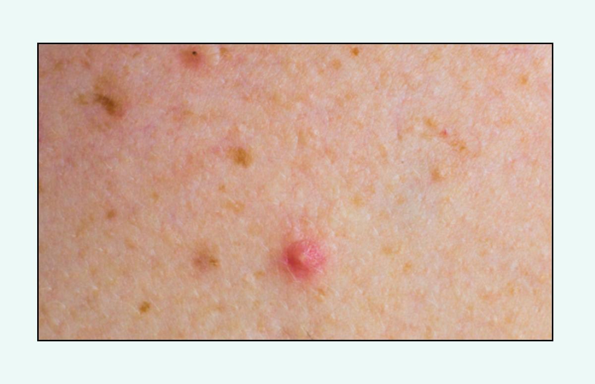 脸上的红疙瘩怎么彻底消除,脸上红疙瘩的种类