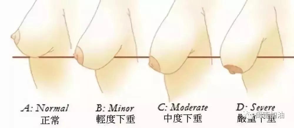 产后胸部重度干瘪下垂怎么提胸,产后胸部下垂瘦胸的动作100%有效