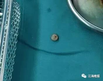 2岁女童误吞了纽扣电池,小孩误吞纽扣电池