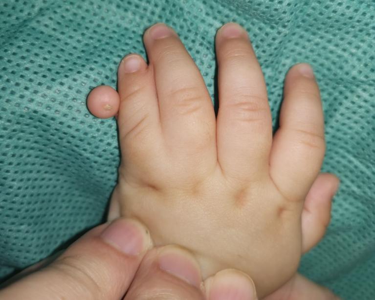 并指畸形免植皮案例,并指畸形