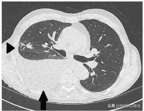 肺癌胸水消失了但气喘严重,肺癌晚期每天抽胸水能活多久