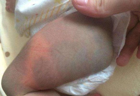 宝宝屁股上淤青怎么回事,宝宝屁股的淤青什么时候会消