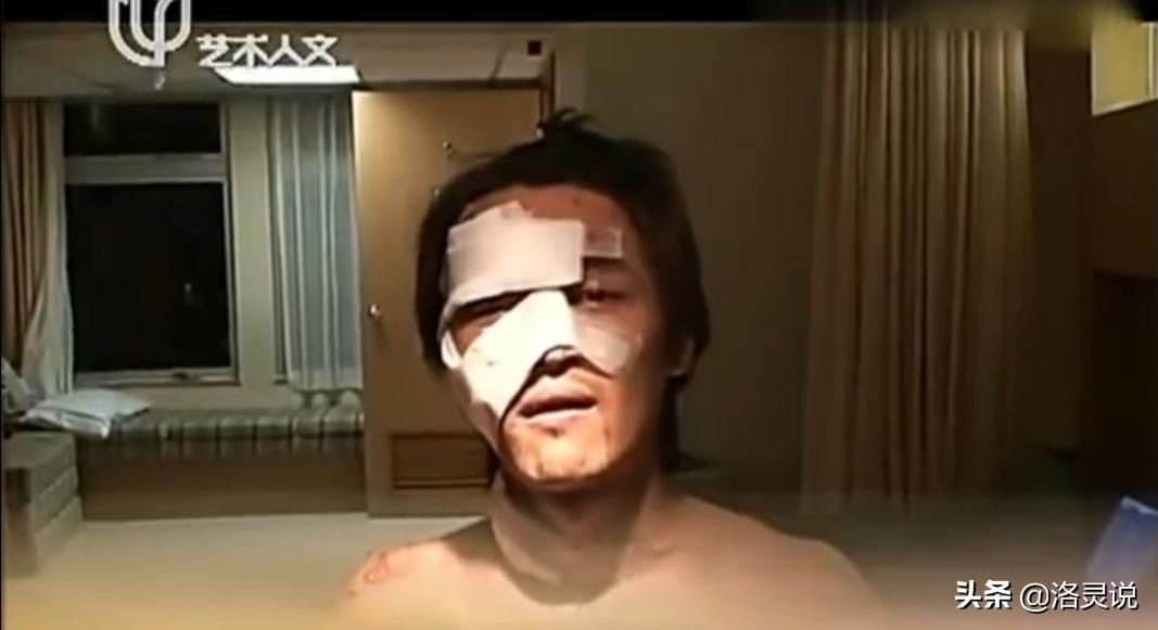 做了上百次整容不敢张嘴,做了2次手术都失败了