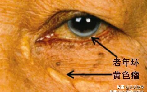 高脂血症饮食原则,高脂血症的饮食治疗方法有哪些