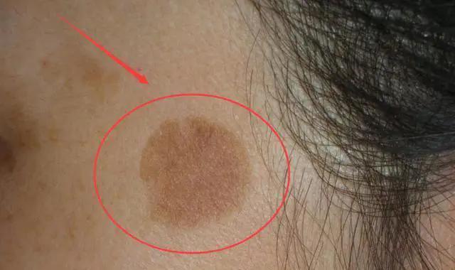 手背上特多老年斑用点什么药膏,老年斑凸起发痒擦什么药膏