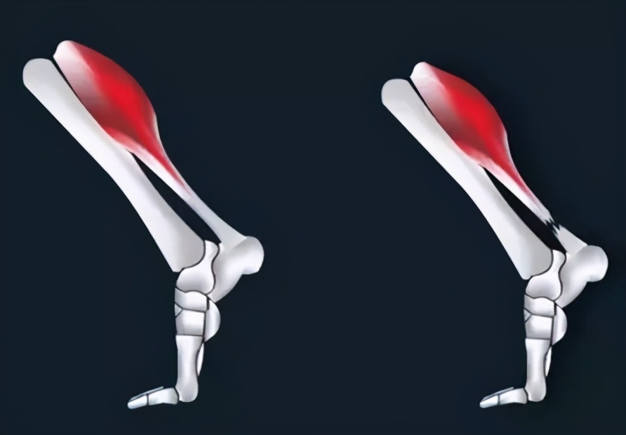 跟腱炎是跟腱断裂的前兆吗,预防跟腱断裂的几个征兆