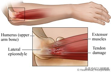 什么是网球肘症状,网球肘热敷治疗有效果吗