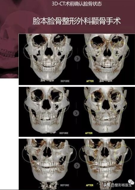 改变脸型除了削骨还有其他办法吗,国字脸磨骨成瓜子脸