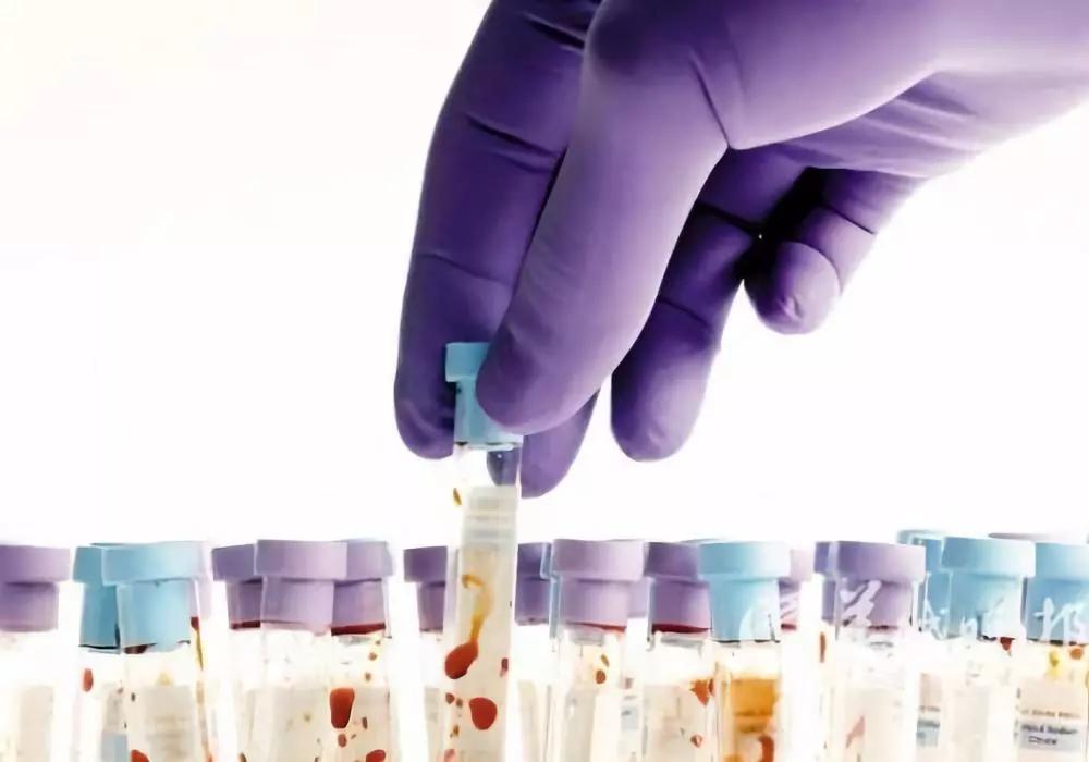 丙型肝炎发展为肝硬化,丙型肝炎为啥治愈了还是阳性