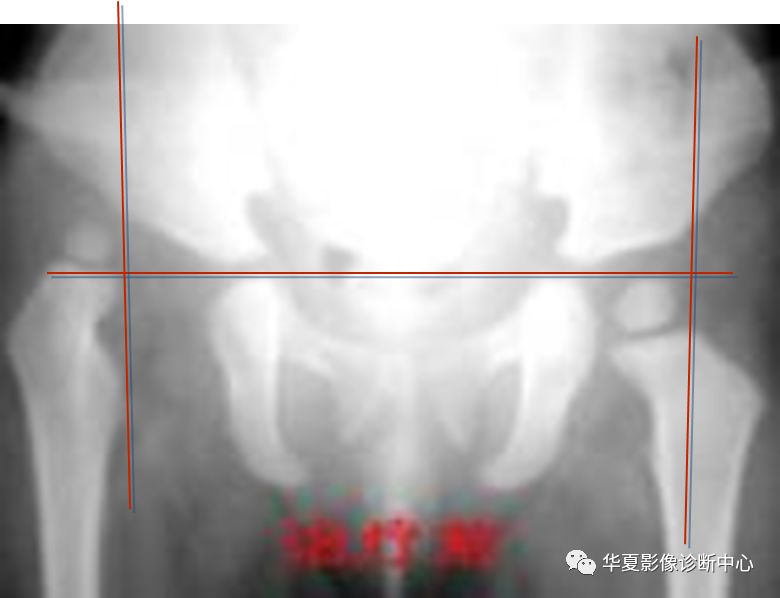 先天性髋关节脱位饮食,先天性髋关节脱位属不属于残疾人