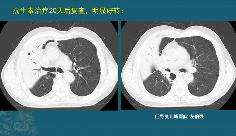 细菌性肺炎吐痰颜色加深,肺炎吐痰粉色需要治疗吗