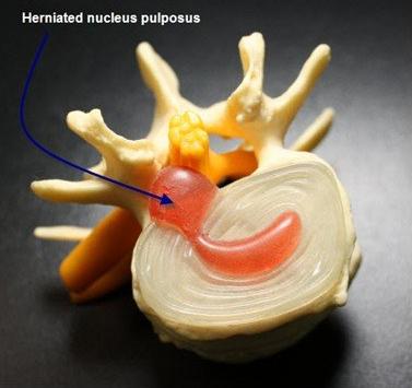 腰椎间盘突出针灸能治彻底吗,腰椎间盘突出针灸治疗能彻底吗