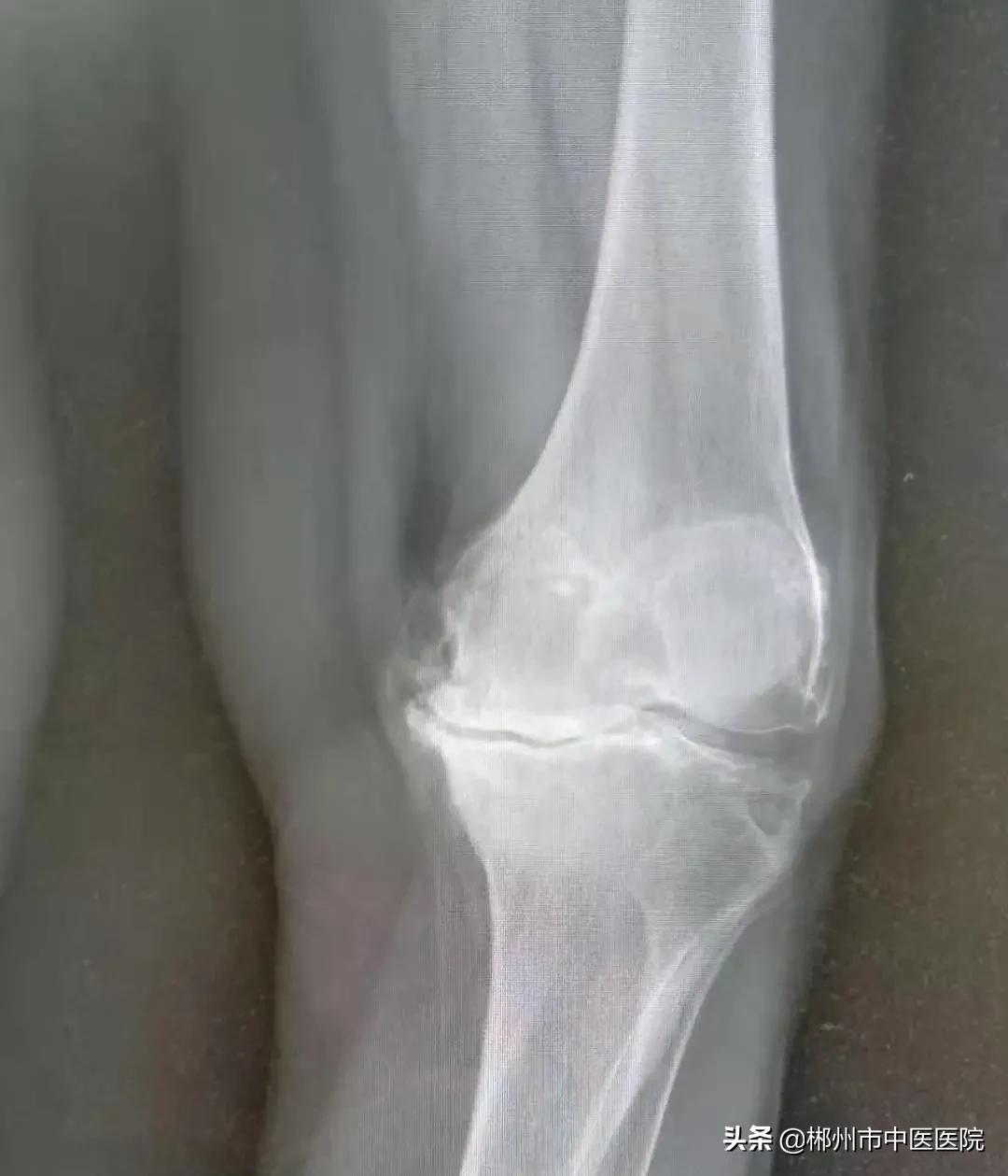 专家支招骨关节炎治疗,膝关节骨性关节炎疼痛怎么治疗