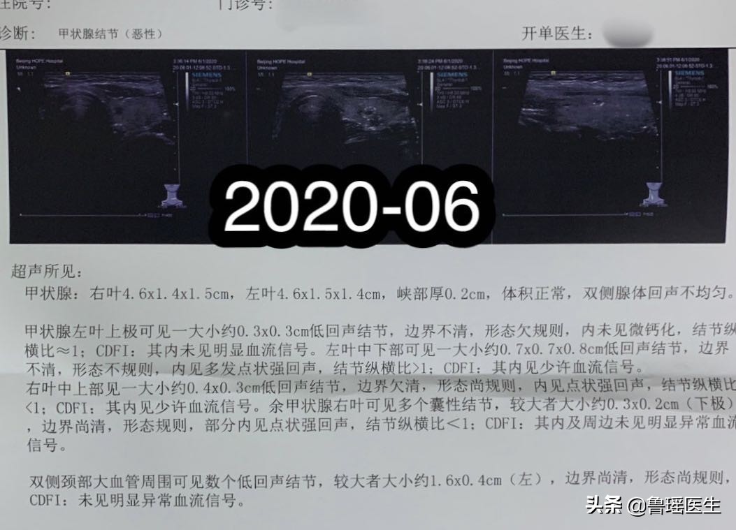 甲状腺结节超声提示恶性五大征象,甲状腺结节b超误诊