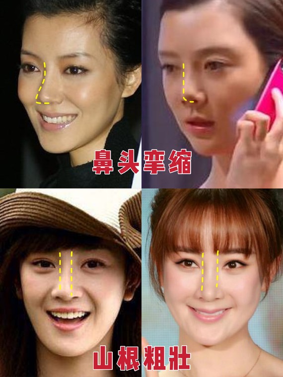 好看的鼻子类型驼峰鼻,好看的鼻型有哪几种