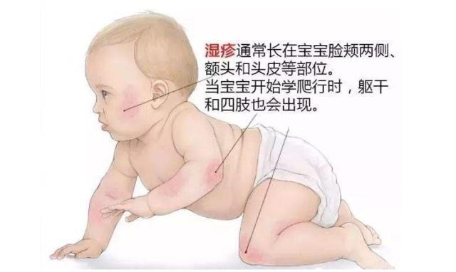 宝宝得湿疹妈妈怎么忌口,宝宝湿疹怎么调理身体才能断根