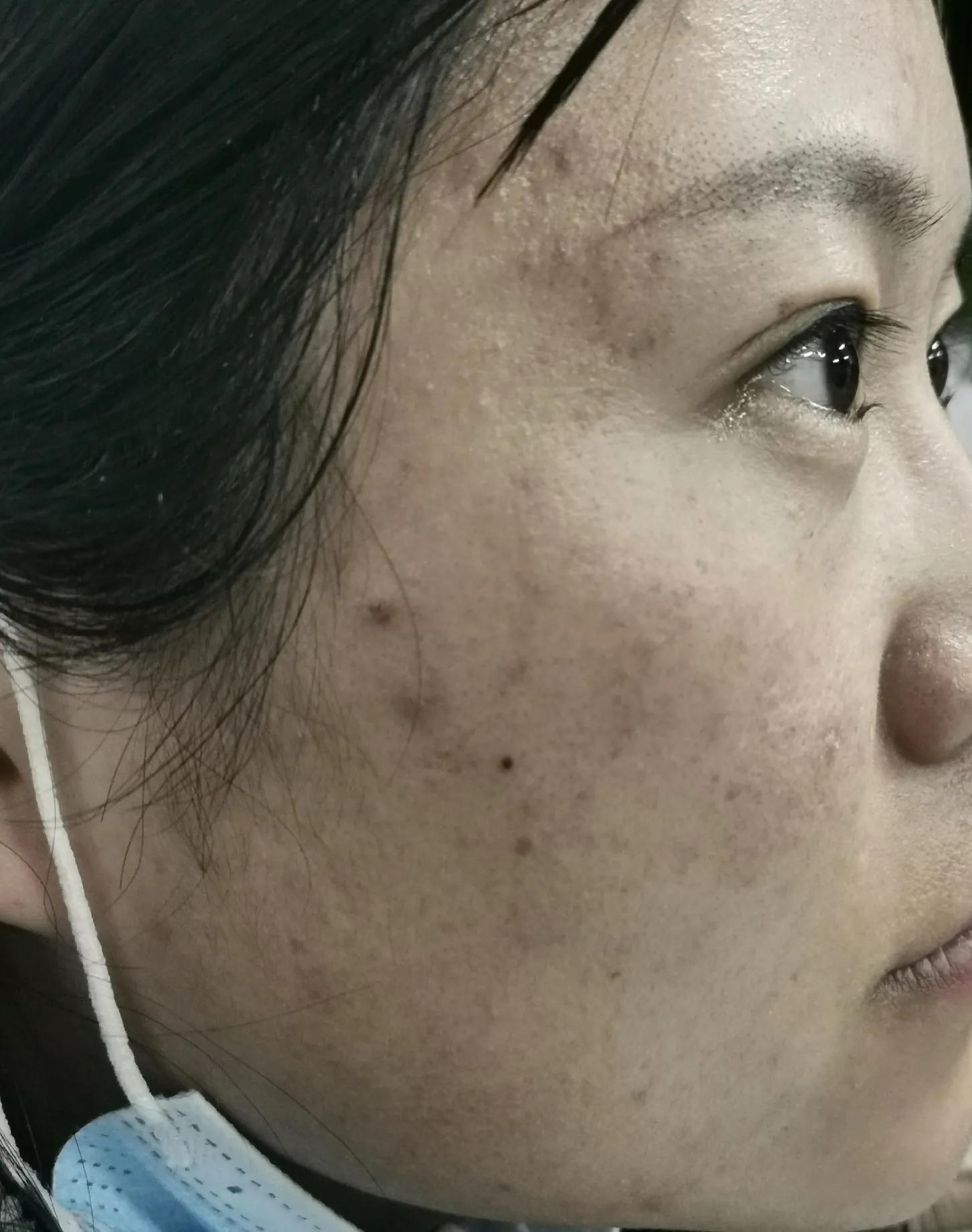 吐血总结祛痘膏,反反复复爆痘怎么都不管用