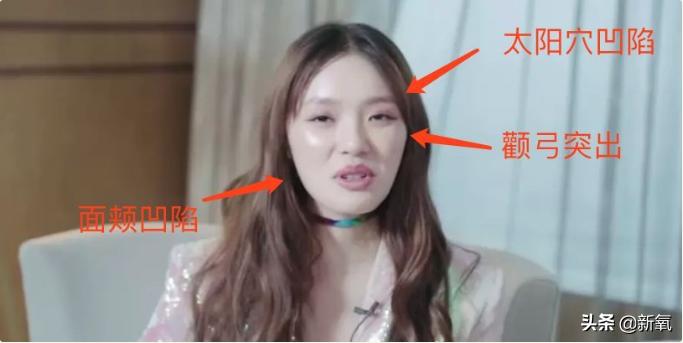 戴牙套真的会出现牙套脸,戴牙套期间牙齿变龅了