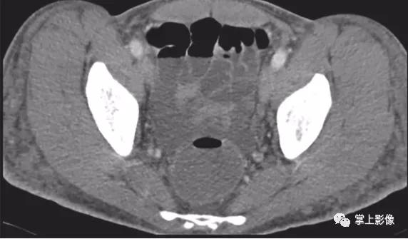 腹壁病变诊断思路,腹部影像诊断读片入门视频