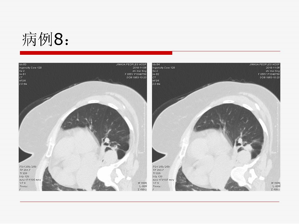 像炎症的肺癌能治好吗,医生说可能是肺癌也可能是炎症