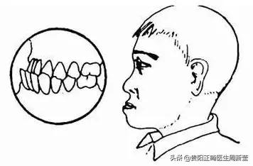 什么是“地包天”，地包天又该如何预防呢？