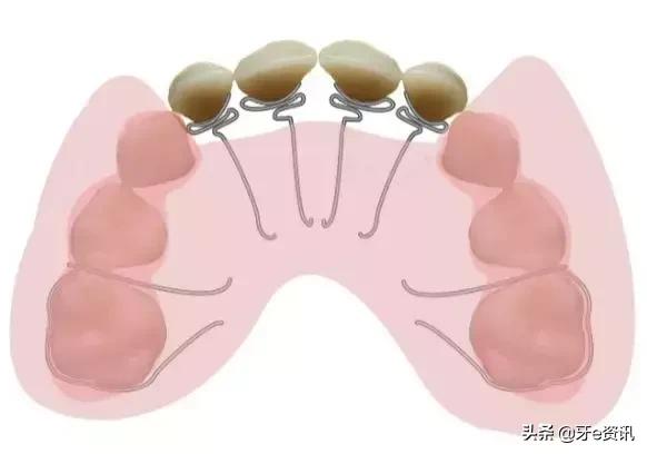 乳牙地包天会自动好吗,乳牙地包天矫正活动器
