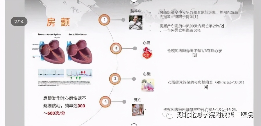 一例罹患多种心律失常病人在宣化二附医院成功实施射频消融术