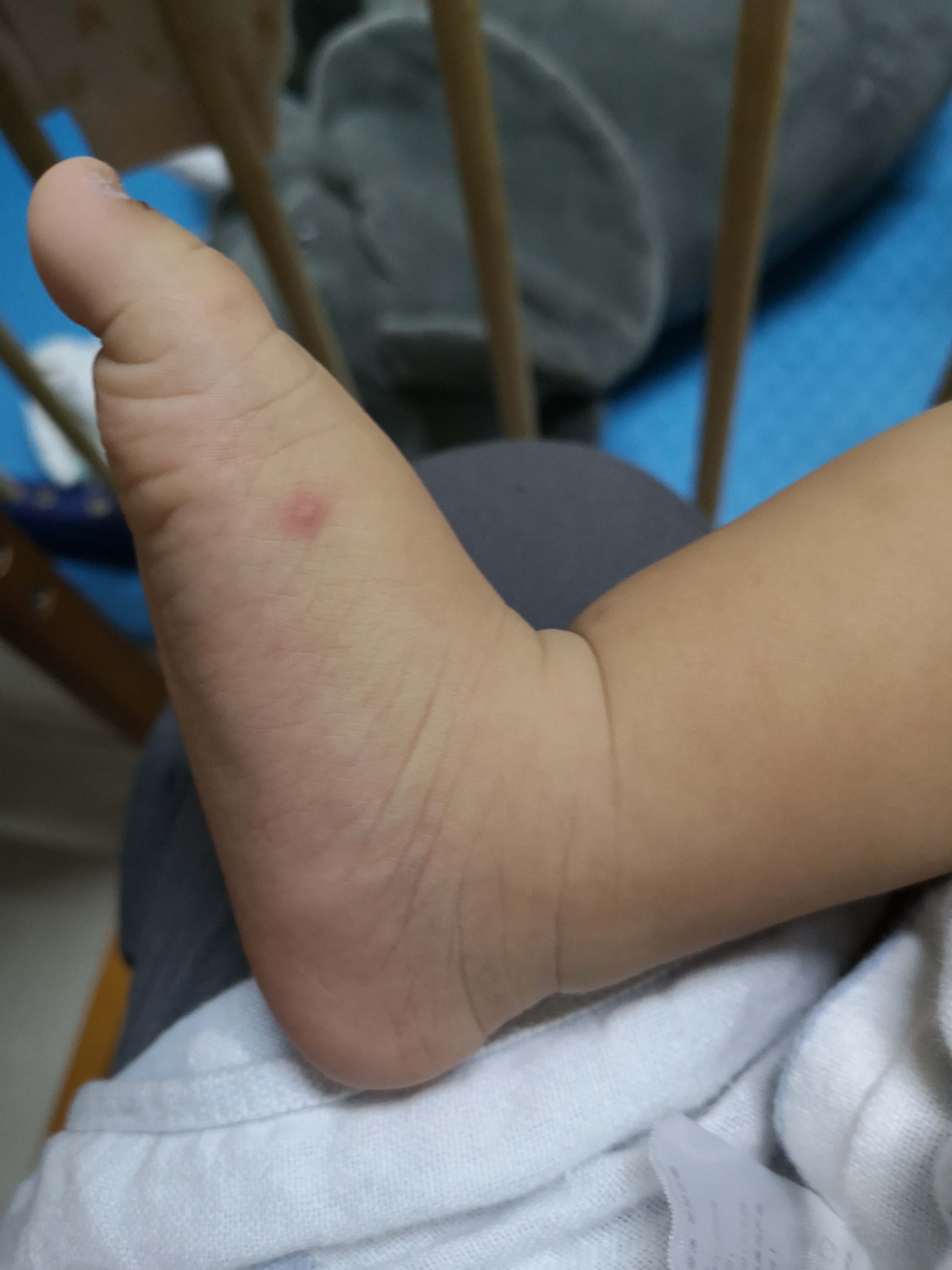 手足口疱疹性咽颊炎进入高发期,手足口高发期孩子有什么症状