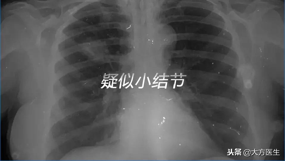 小结节8毫米怎么治疗,身体有小结节怎么办