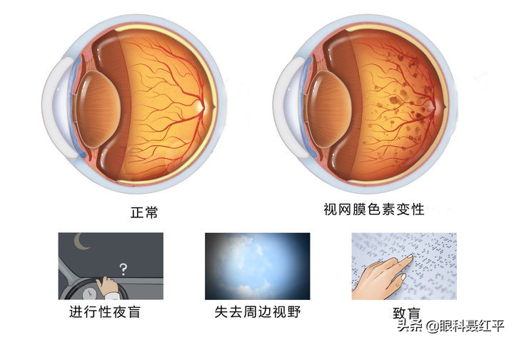 视网膜色素变性新药上市,视网膜色素变性四大饮食禁忌