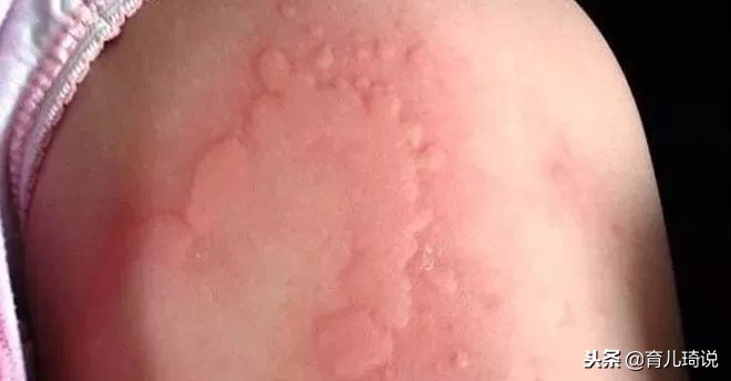 不要以为*麻疹荨**是大人的专利,岂不知小宝宝也会得,比大人更难治