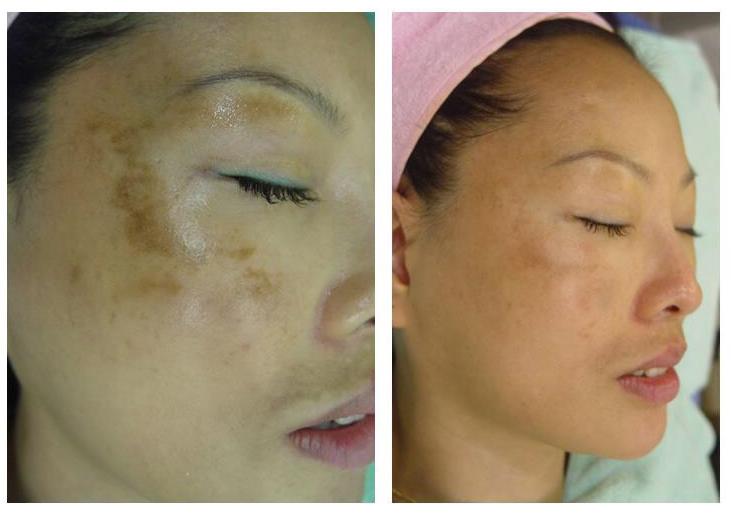 怎么改善肤色黄暗沉,怎么才能改善暗黄淡斑