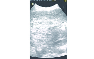 肝血管瘤不治会怎么样,肝血管瘤切除术后一个月复查什么