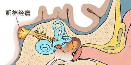 30岁男子右耳堵塞听力下降,46岁男性突然一只耳朵听力下降
