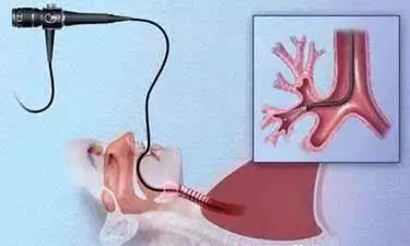 科普一下，纤维支气管镜在儿科有哪些作用？