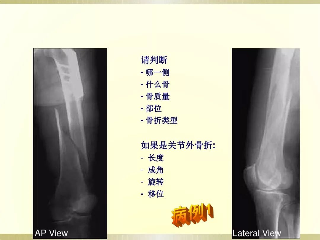 骨科x光片读片技巧,放射科骨科读片教程
