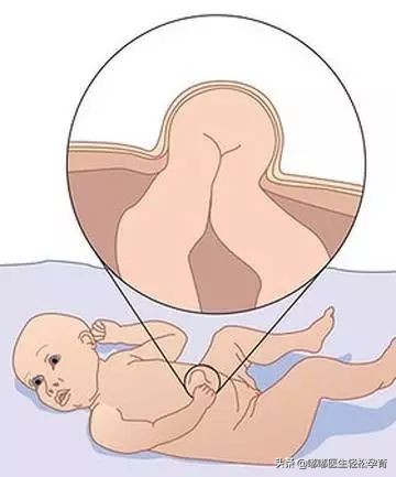 无知父母帮孩子放气,无知的父母不知道小儿脐疝